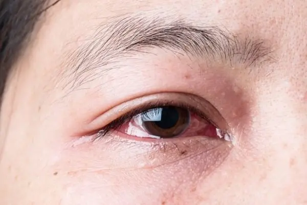 Kính áp tròng kém chất lượng là nguyên nhân gây ra rất nhiều vấn đề về mắt