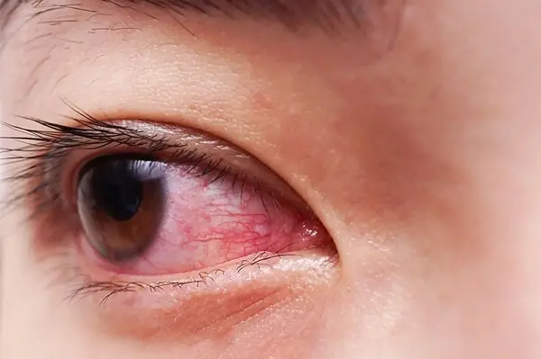 Mắt có thể bị nhiễm trùng khi đeo lens khi đi tắm